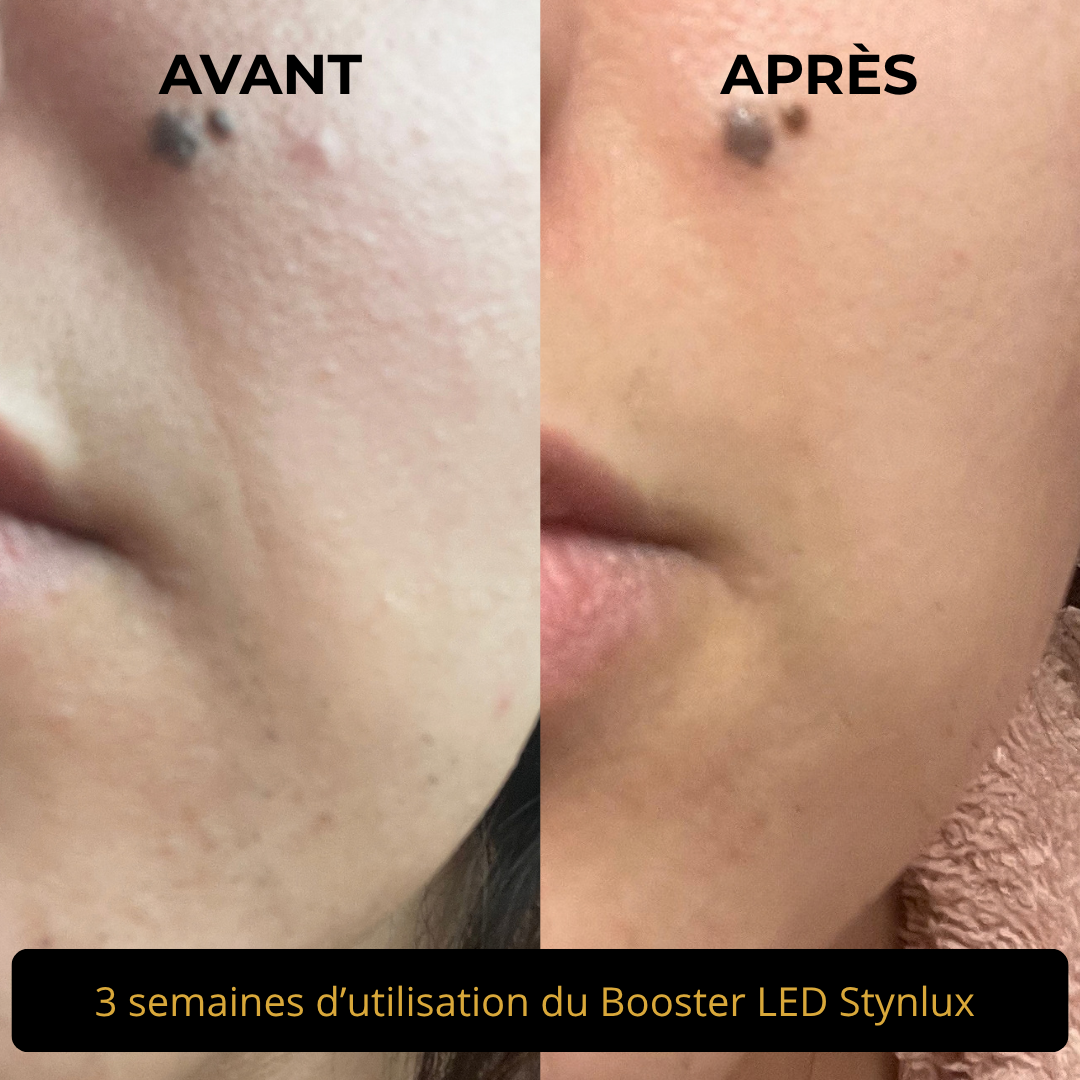 Booster LED visage 4 en 1 STYNLUX